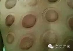 拔上一罐，病去一半！