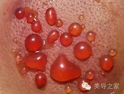 拔上一罐，病去一半！