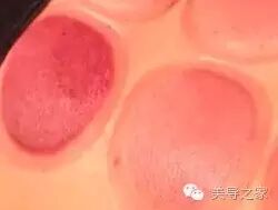 拔上一罐，病去一半！