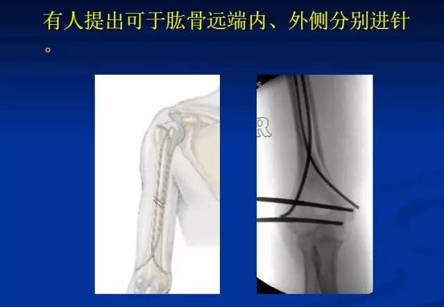 课件 河北三院弹性髓内钉治疗儿童肱骨干骨折的技巧