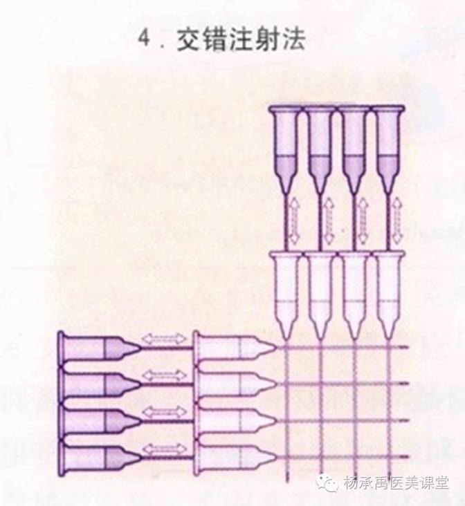 进针角度呈30–45度,也可平行进针,这因个人习惯而不同.