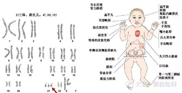 常识链接: * 什么是&ldquo;唐氏综合征&rdquo; 唐氏综合征俗称先天性痴呆.它是最常见的一种染色体疾病,大约每750个新生儿就会有1...
