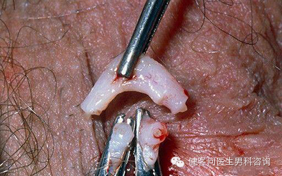 为什么叫蚊式钳惊！实拍男人结扎手术全过程（血腥组图，慎入）_https://www.jmylbn.com_新闻资讯_第9张