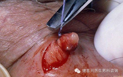 为什么叫蚊式钳惊！实拍男人结扎手术全过程（血腥组图，慎入）_https://www.jmylbn.com_新闻资讯_第12张