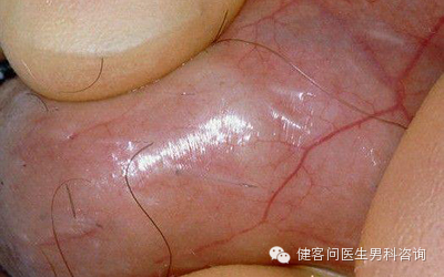 为什么叫蚊式钳惊！实拍男人结扎手术全过程（血腥组图，慎入）_https://www.jmylbn.com_新闻资讯_第2张