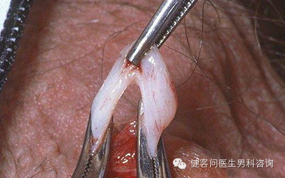 为什么叫蚊式钳惊！实拍男人结扎手术全过程（血腥组图，慎入）_https://www.jmylbn.com_新闻资讯_第7张