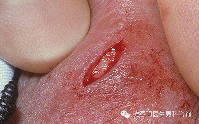 为什么叫蚊式钳惊！实拍男人结扎手术全过程（血腥组图，慎入）_https://www.jmylbn.com_新闻资讯_第13张