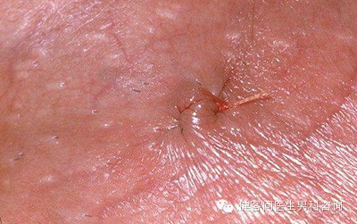 为什么叫蚊式钳惊！实拍男人结扎手术全过程（血腥组图，慎入）_https://www.jmylbn.com_新闻资讯_第14张