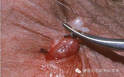 为什么叫蚊式钳惊！实拍男人结扎手术全过程（血腥组图，慎入）_https://www.jmylbn.com_新闻资讯_第11张