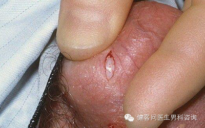 为什么叫蚊式钳惊！实拍男人结扎手术全过程（血腥组图，慎入）_https://www.jmylbn.com_新闻资讯_第4张