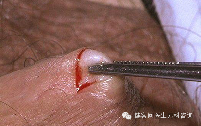 为什么叫蚊式钳惊！实拍男人结扎手术全过程（血腥组图，慎入）_https://www.jmylbn.com_新闻资讯_第5张