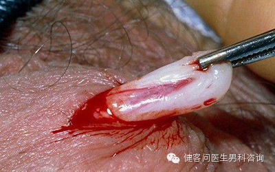 为什么叫蚊式钳惊！实拍男人结扎手术全过程（血腥组图，慎入）_https://www.jmylbn.com_新闻资讯_第6张