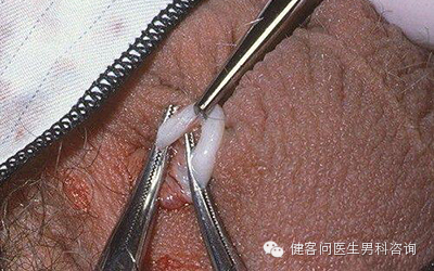 为什么叫蚊式钳惊！实拍男人结扎手术全过程（血腥组图，慎入）_https://www.jmylbn.com_新闻资讯_第8张