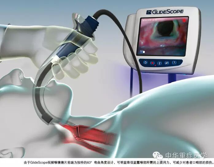 普通喉镜怎么使用GlideScope®视频喉镜使用与维护_https://www.jmylbn.com_新闻资讯_第3张