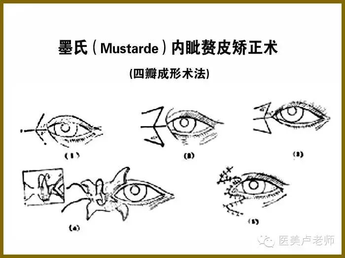 小眼开大整形术