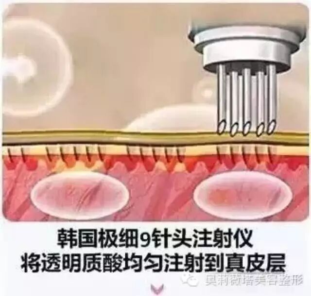 钟丽缇谈水光注射,为什么你的效果不够好?