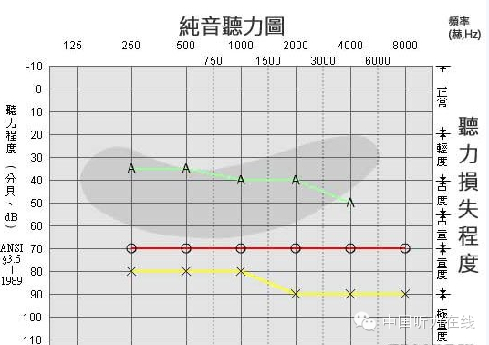 听力小百科：您会看听力图吗？