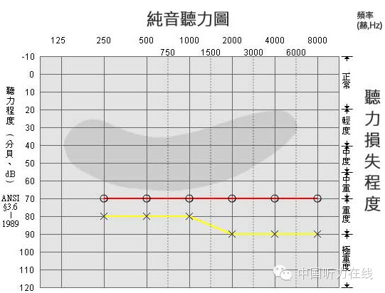 听力小百科：您会看听力图吗？