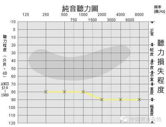 听力小百科：您会看听力图吗？