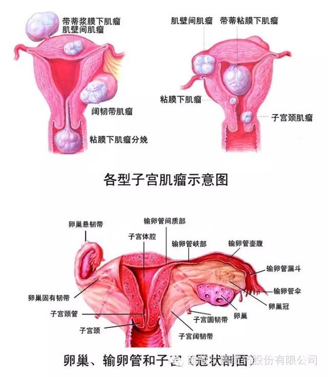 难以之隐得了子宫肌瘤是不是只能做手术