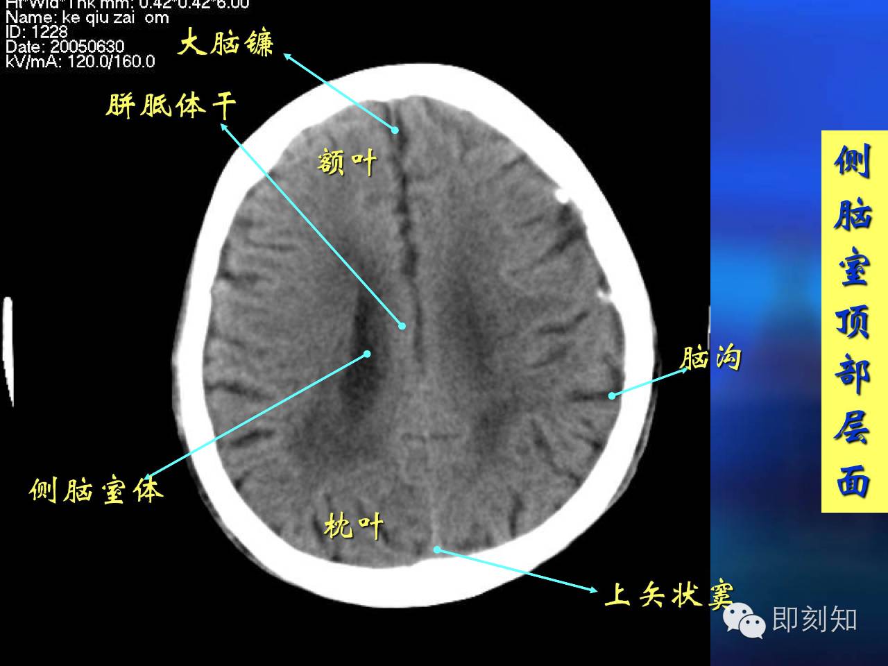 【大脑揭秘】颅脑ct横断层解剖