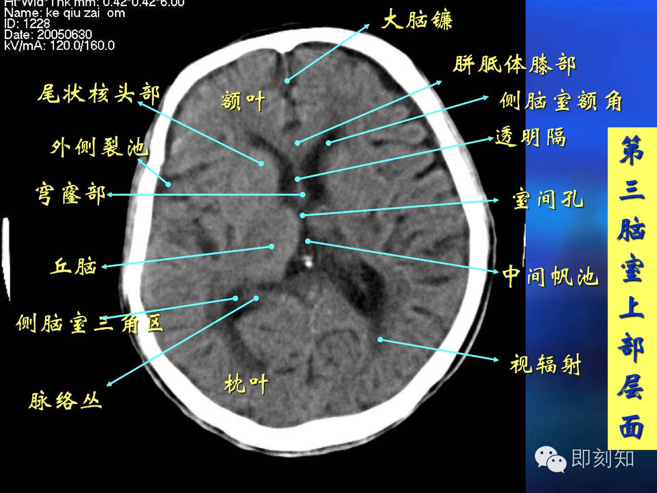 【国内苗木批发分享组【大脑揭秘】颅脑ct横断层解剖