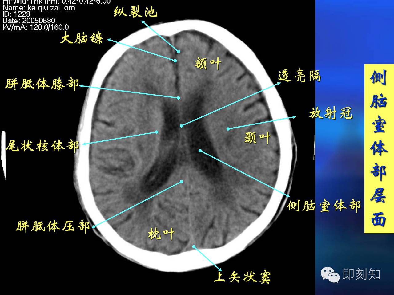 【大脑揭秘】颅脑ct横断层解剖