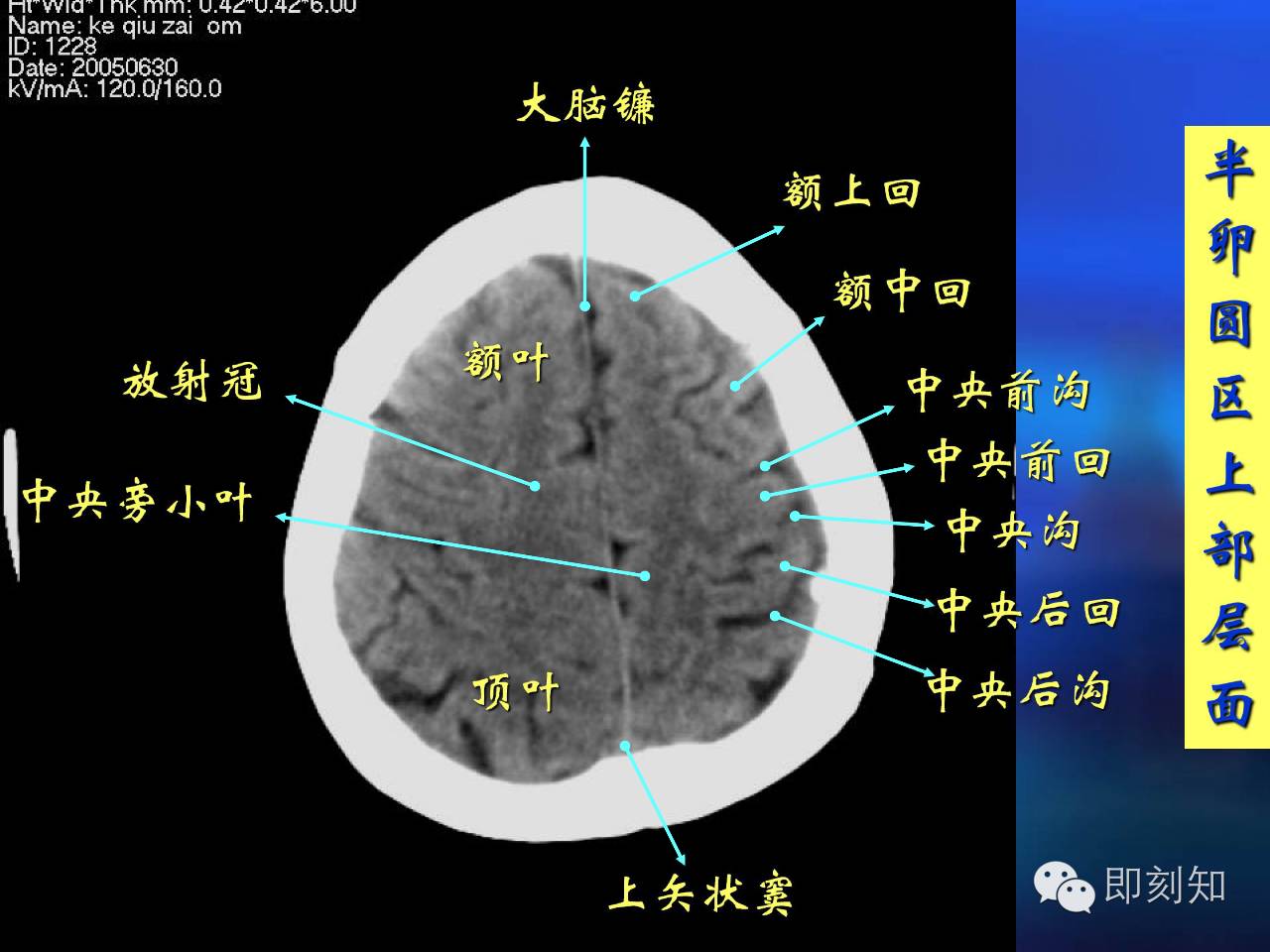 【大脑揭秘】颅脑ct横断层解剖