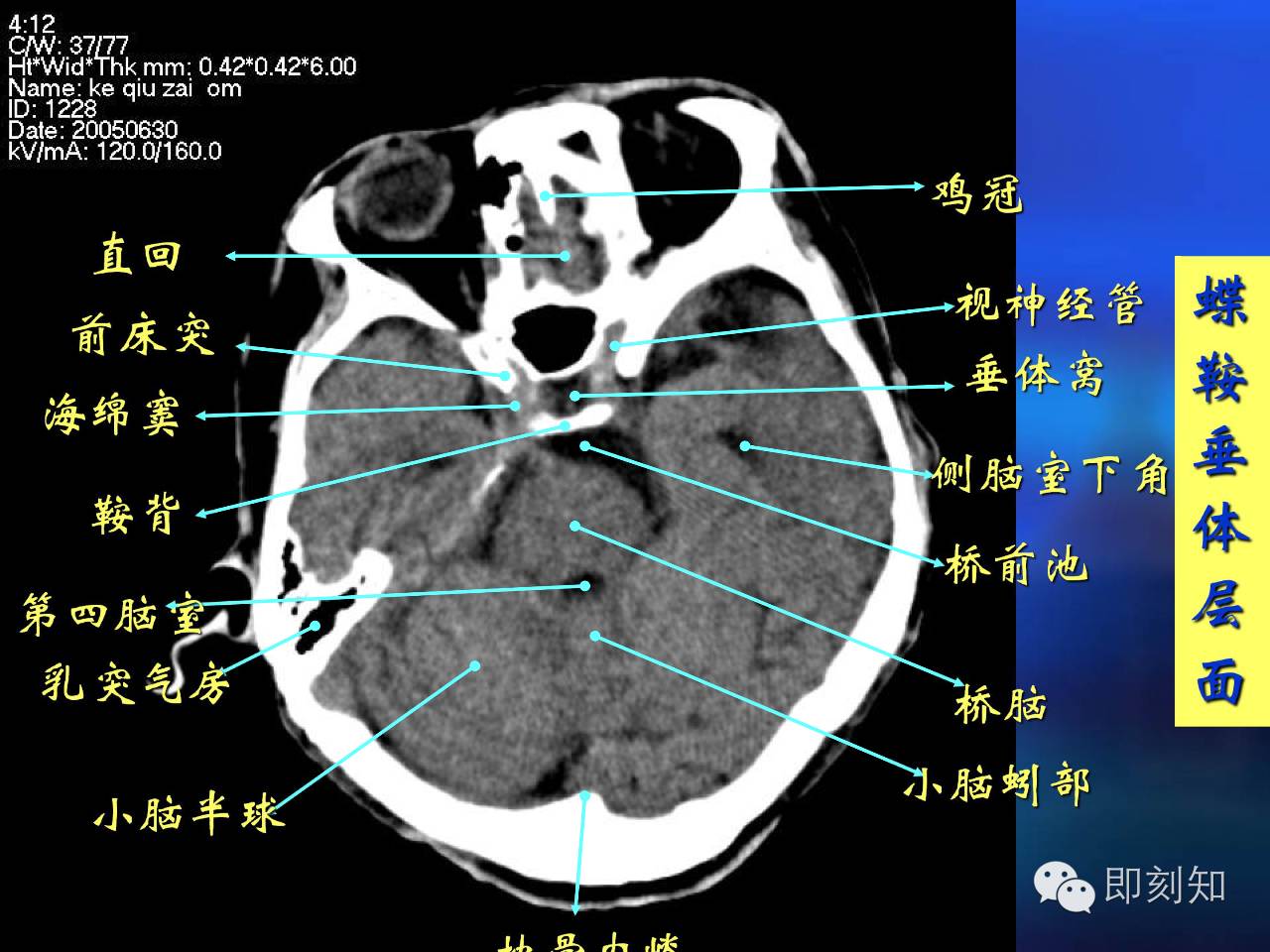 【大脑揭秘】颅脑ct横断层解剖