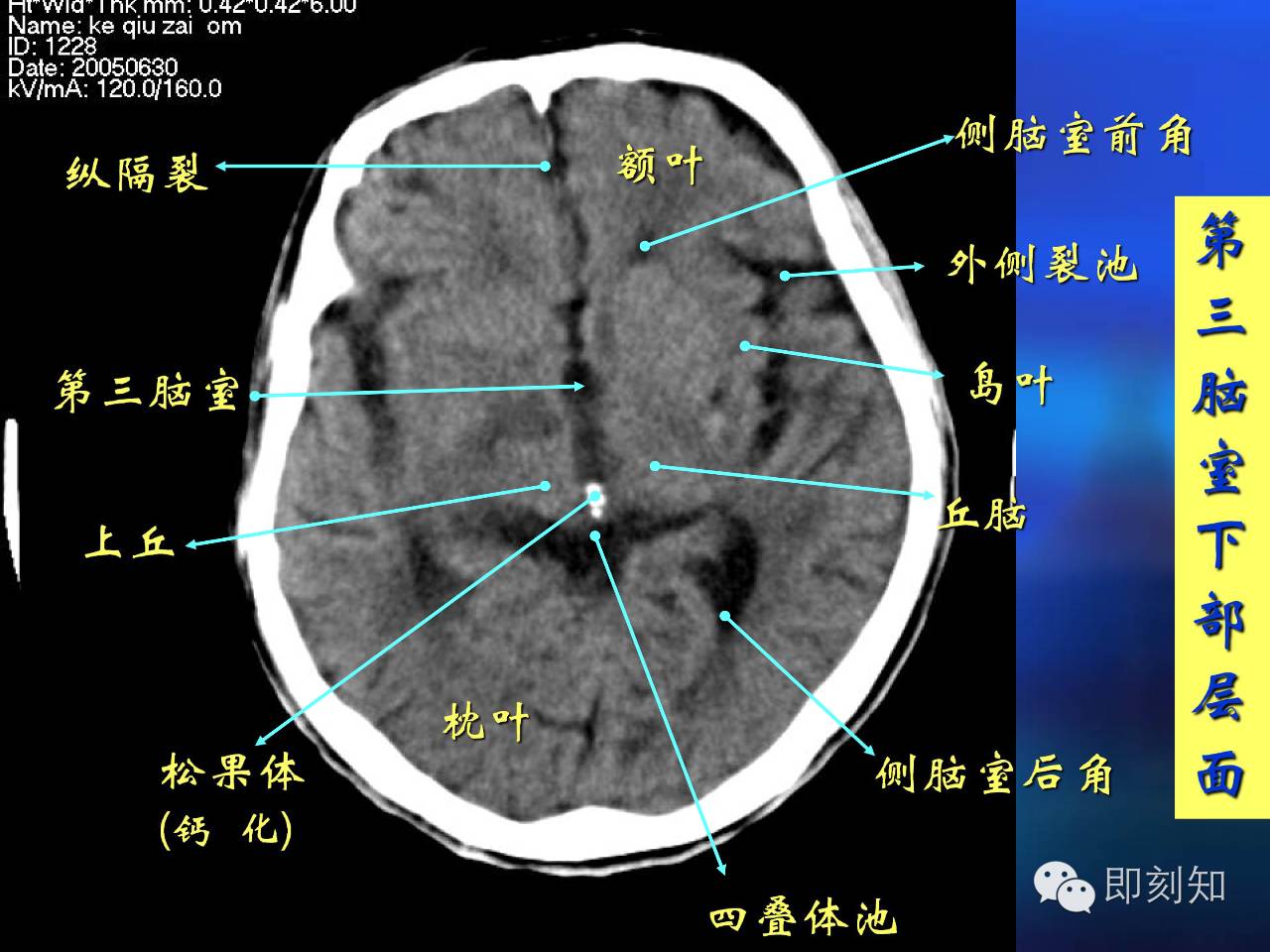 【大脑揭秘】颅脑ct横断层解剖