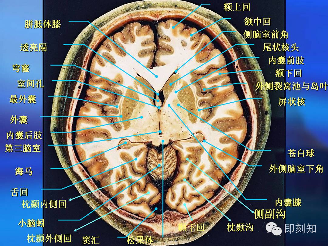 【大脑揭秘】颅脑ct横断层解剖