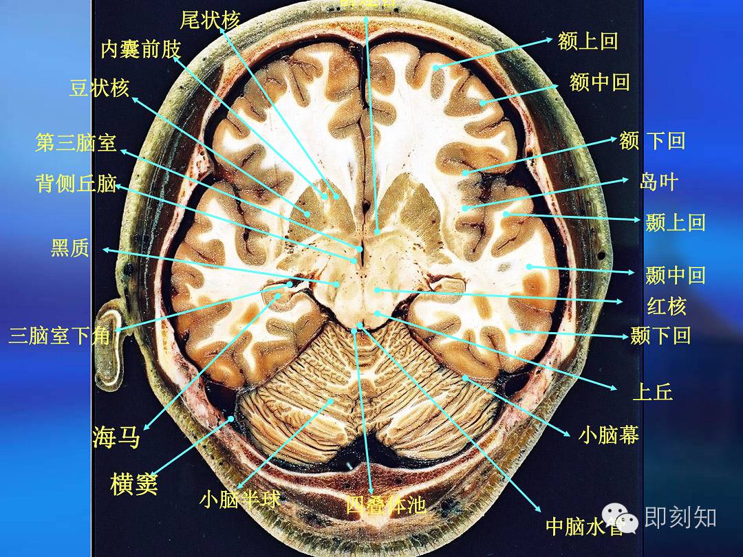 【大脑揭秘】颅脑ct横断层解剖