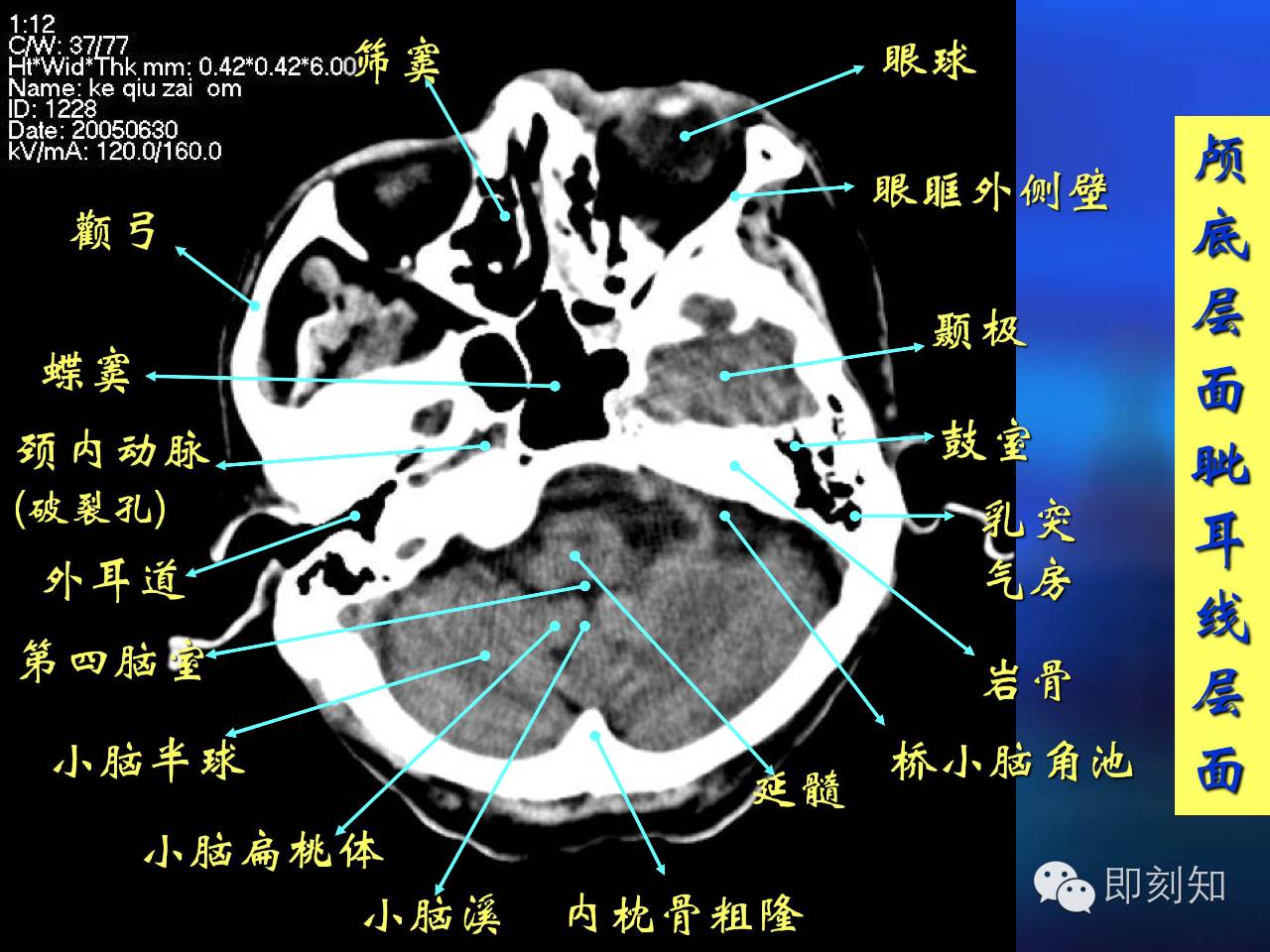 【大脑揭秘】颅脑ct横断层解剖