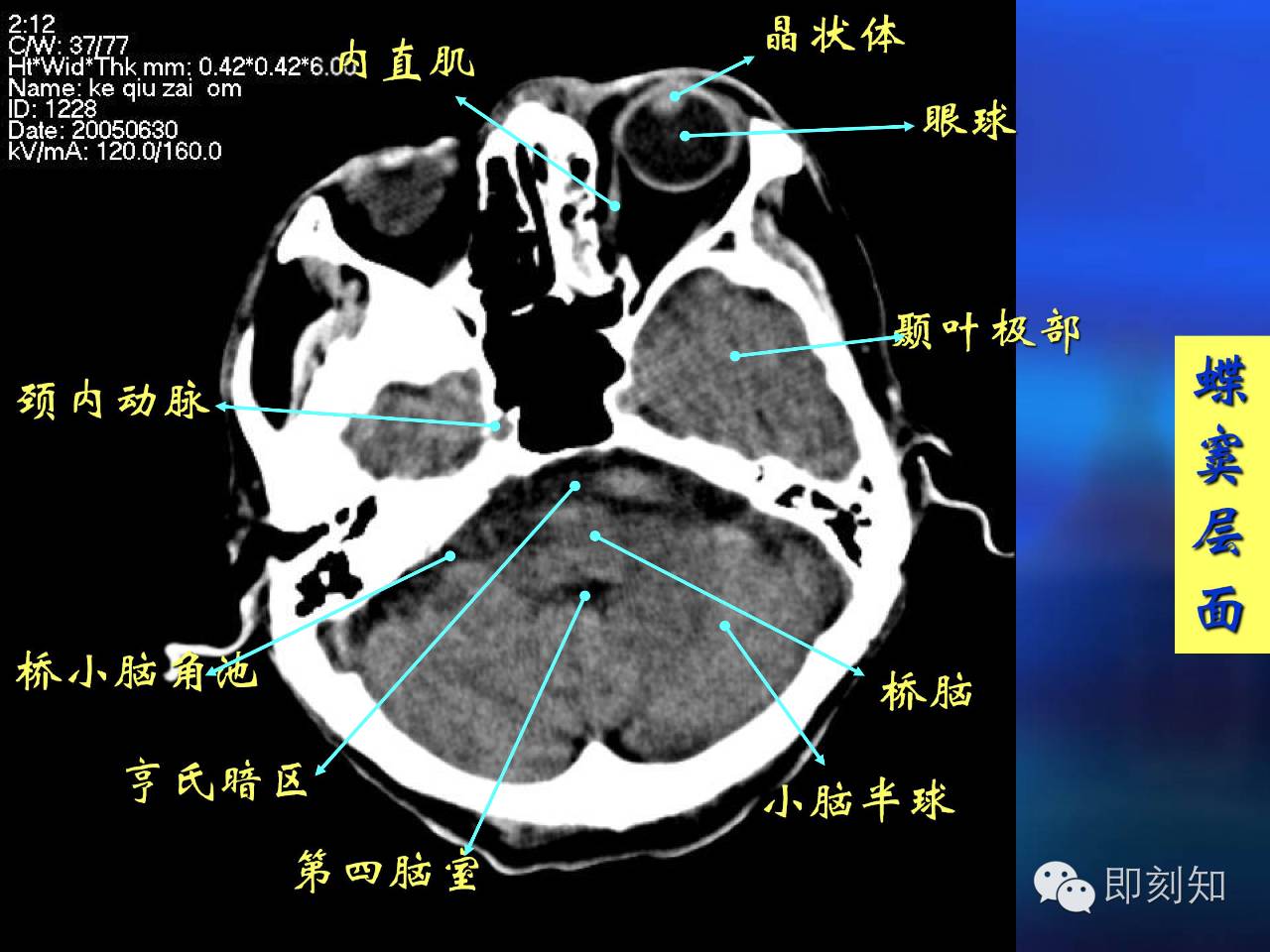 【大脑揭秘】颅脑ct横断层解剖
