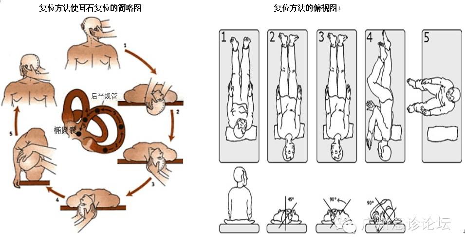 良性阵发性位置性眩晕(耳石症)手法复位