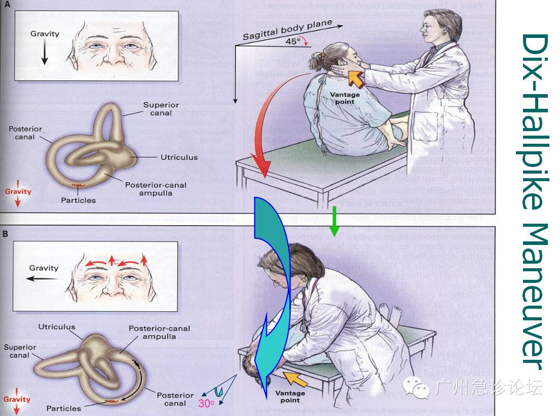 良性阵发性位置性眩晕(耳石症)手法复位