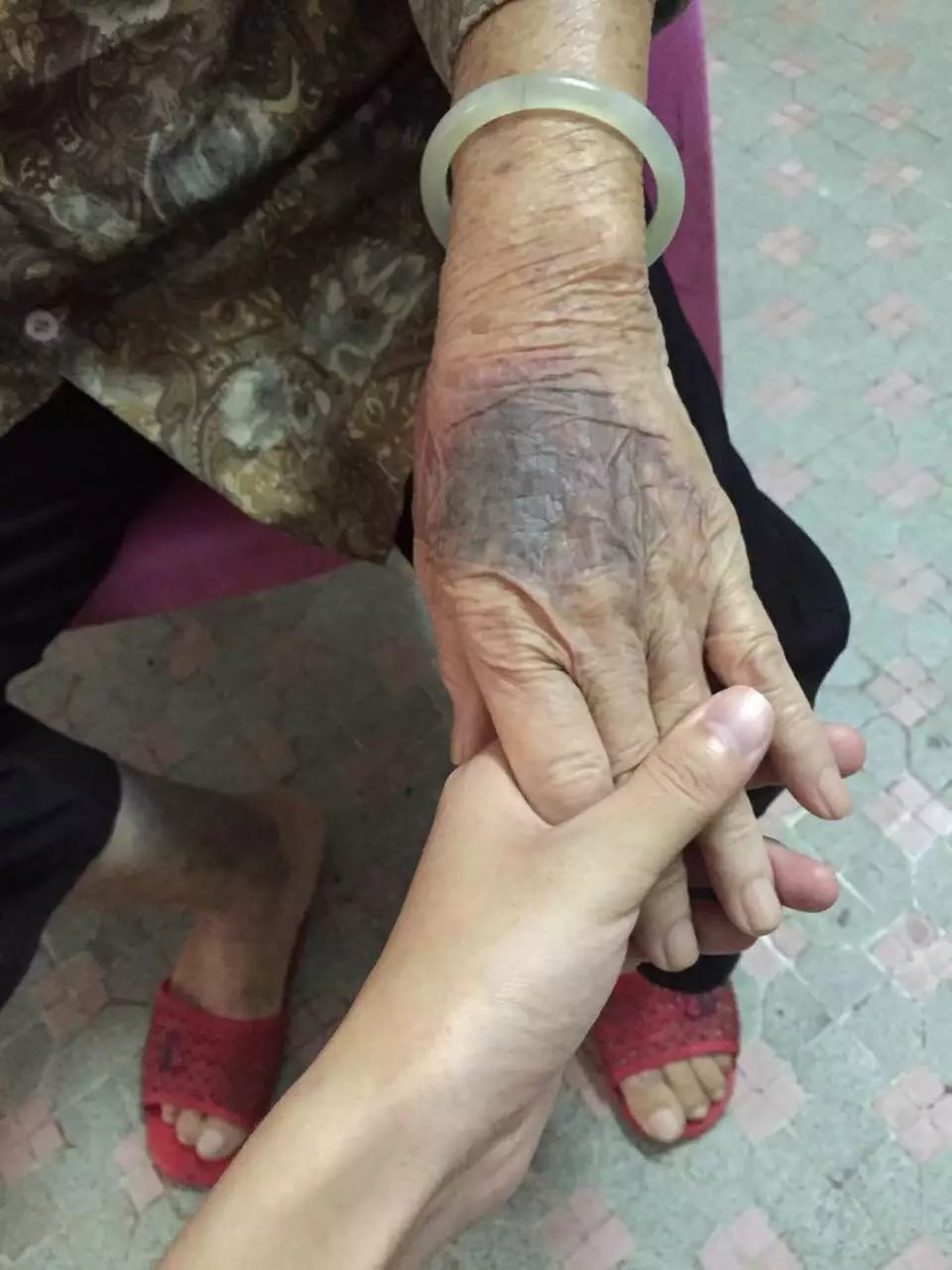 紧急!阳江一名80岁老人突发性大面积皮下出血,生命危殆,急需大量血源!