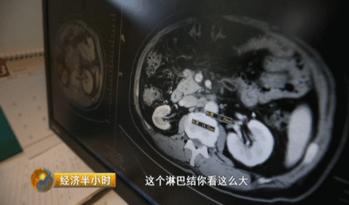 世界最新抗癌藥中國(guó)也能造 一年治療費(fèi)用不超10萬(wàn)