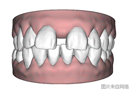 一张图看懂牙齿矫正过程