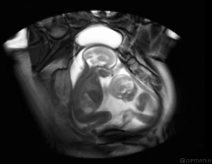 杨颖怀孕,夫妇整容疑云即将揭晓-怀孕期