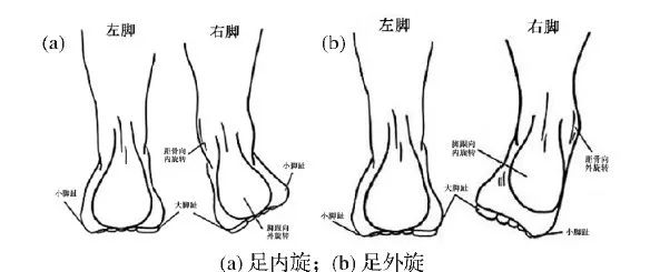 常见非正常足翻转类型适合不同足弓和足翻转类型的跑鞋.