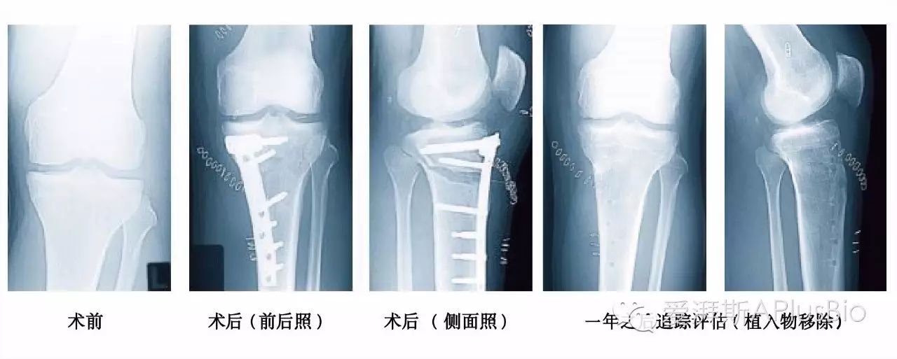 胫骨高位截骨术免换人工关节让您行动自如保骨本