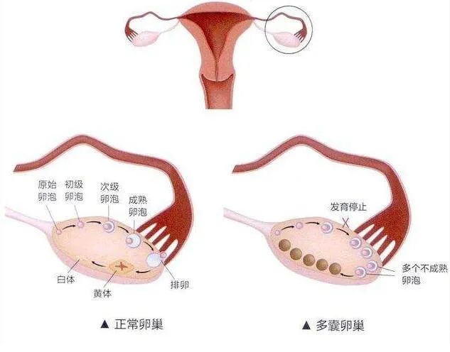 多囊卵巢综合征是什么方式造成的?治疗方式主要有两种