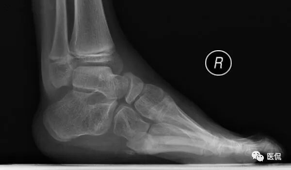 人体骨骼足部_足部骨骼图_足部骨骼构造