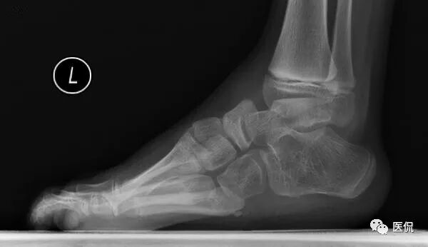 足部骨骼构造_人体骨骼足部_足部骨骼图