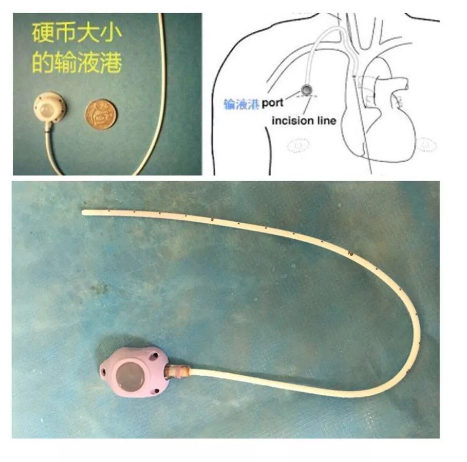 输液港扎针最全示范,再也不怕病人说技术不到位了