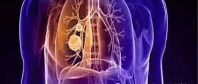 Ⅳ期原发性肺癌中国治疗指南（2021年版）