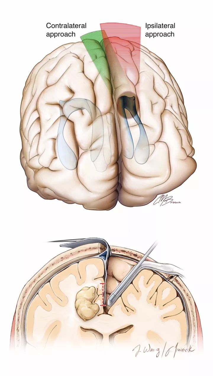 对侧半球间,经大脑镰-经楔前叶入路-the neurosurgical atlas系列