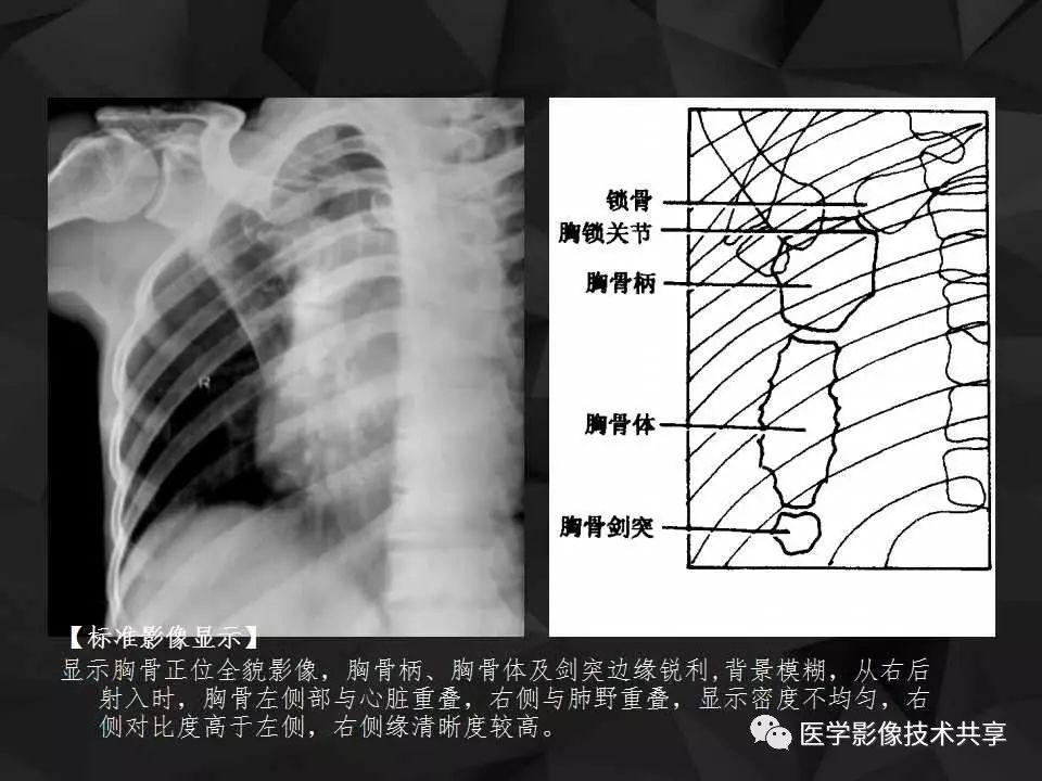 胸骨正位摄影时应采用低千伏,小毫安,长时间,近距离并倾斜中心线的