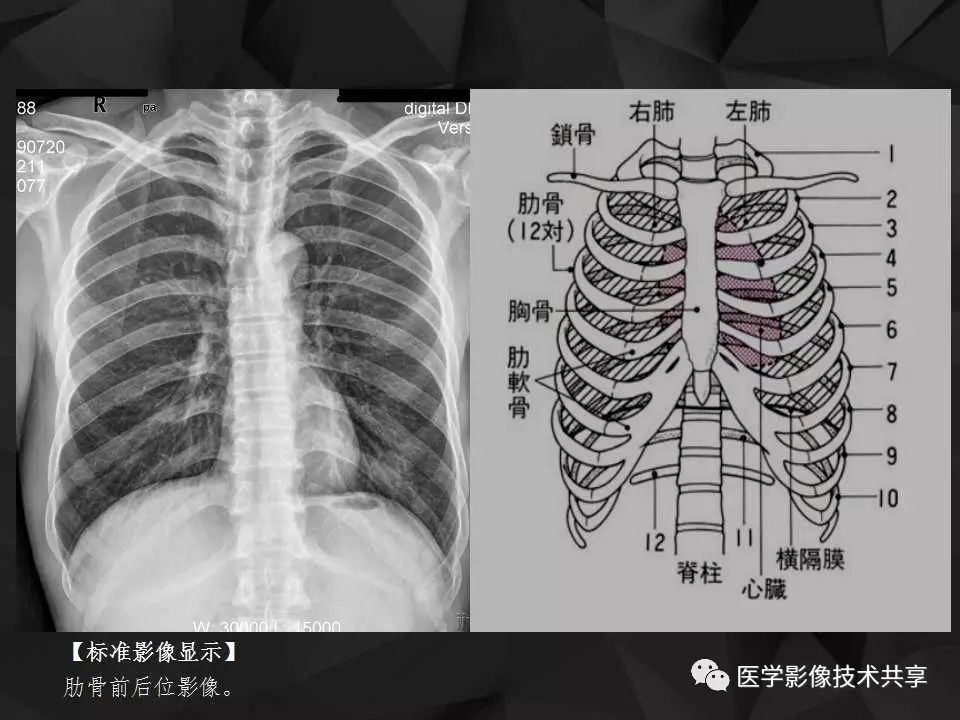 胸骨正位摄影时应采用低千伏,小毫安,长时间,近距离并倾斜中心线的